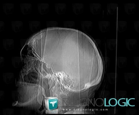 Parietal thinning, Skull vault, X rays