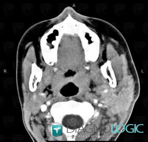 Parotitis, Parotid and other salivary glands, CT