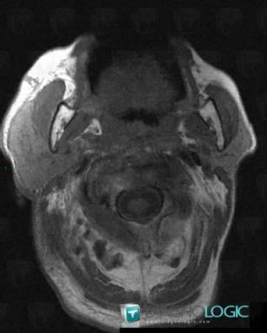 Parotitis, Parotid and other salivary glands, MRI