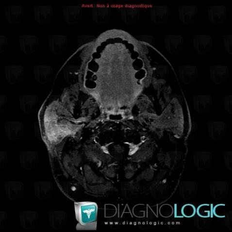 Parotitis, Parotid and other salivary glands, MRI