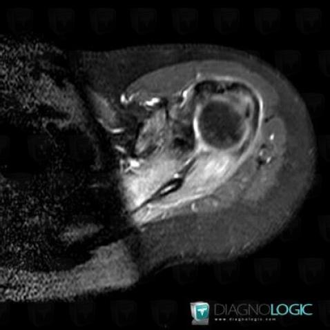 Parsonage-Turner syndrome, Muscles - Shoulder, MRI