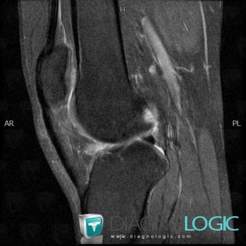 Patella alta, Patella, IRM