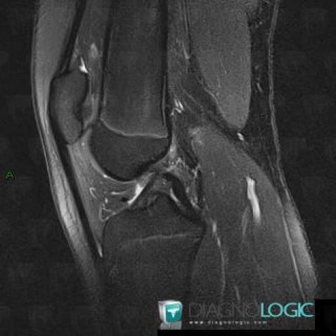 Patella alta, Patella, MRI