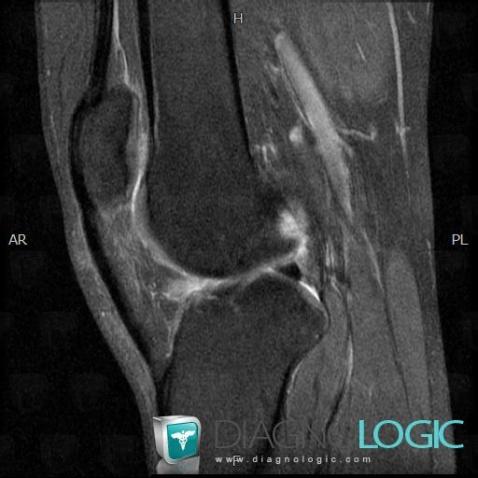 Patella alta, Patella, MRI