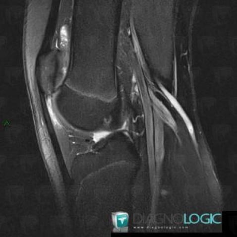 Patellar tendon lateral femoral condyle friction syndrome, Other soft tissues/nerves - Knee, MRI