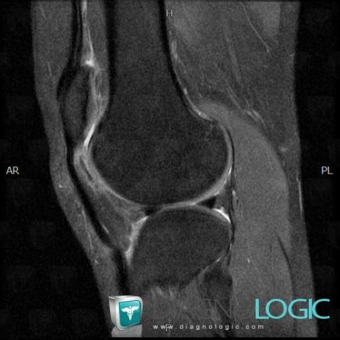 Patellar tendon lateral femoral condyle friction syndrome, Other soft tissues/nerves - Knee, MRI