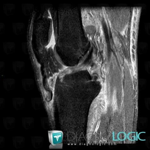 Patellar tendon rupture , Patellar tendon, MRI