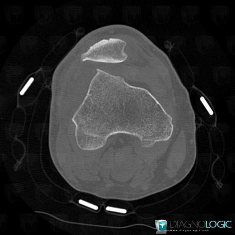 Patellofemoral Dysplasia , Femur - Distal part, CT