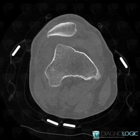 Patellofemoral Dysplasia , Patella, CT