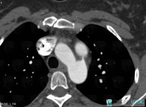 Patent ductus arteriosus, Aorta, Pulmonary artery, CT