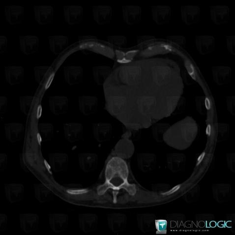 Pectus excavatum, Sternum, CT