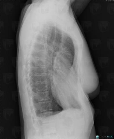 Pectus excavatum, Sternum, X rays