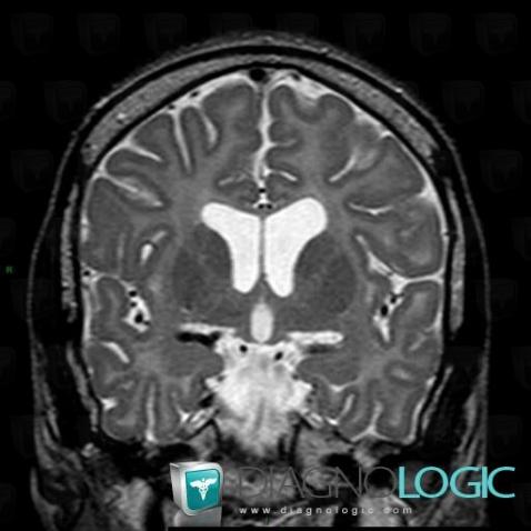 Pelizaeus-Merzbacher disease, Cerebral hemispheres, Ventricles / Periventricular region, MRI