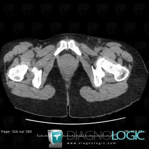 Pelvis / Périnée, Paroi abdominale, TDM