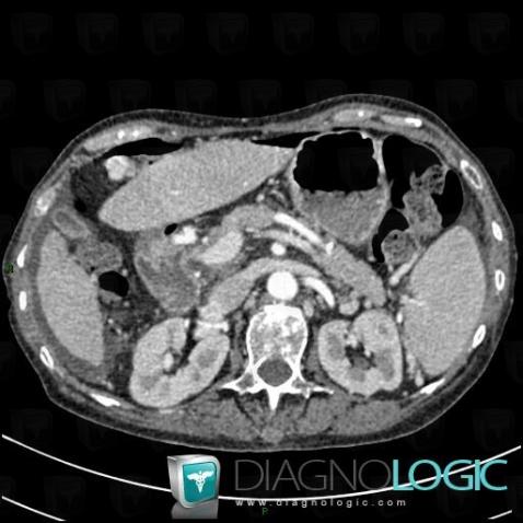 Peptic ulcer, Duodenum, CT