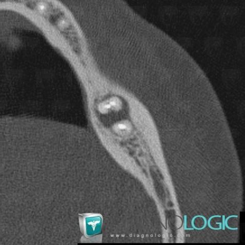 Periapical cyst, Mandible, CT