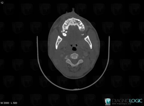 Periapical cyst, Maxilla, CT