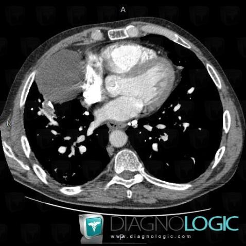 Pericardial cyst, Mediastinum, CT