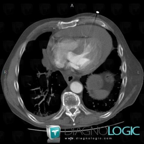 Pericardial effusion, Cardiac cavities / Pericardium, CT