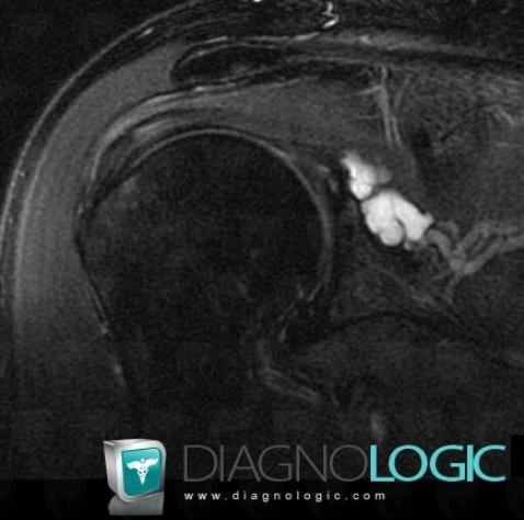 Perilabral cyst, Gleno humeral joint, Other soft tissues/nerves - Shoulder, MRI