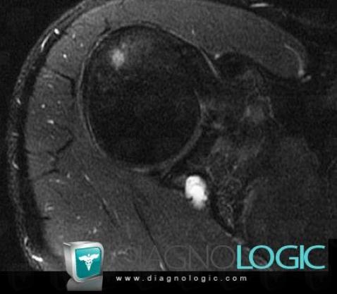 Perilabral cyst, Other soft tissues/nerves - Shoulder, MRI