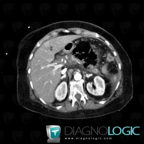 Peripancreatic collection, Mesentery / Peritoneum, CT