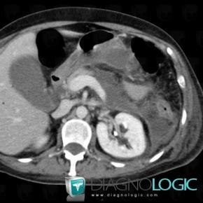 Peripancreatic collection, Mesentery / Peritoneum, CT