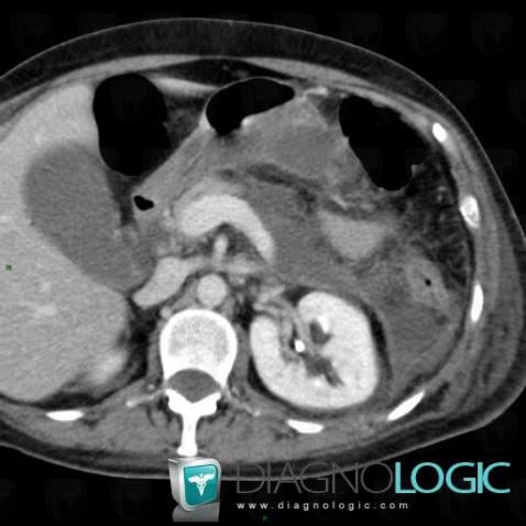 Peripancreatic collection, Mesentery / Peritoneum, CT