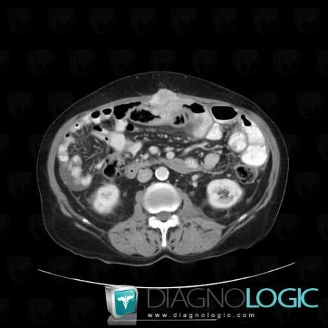 Peritoneal carcinomatosis, Abdominal wall, CT