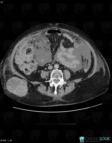 Peritoneal carcinomatosis, Caecum / Appendix, CT