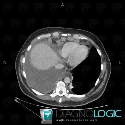 Peritoneal carcinomatosis, Mediastinum, CT