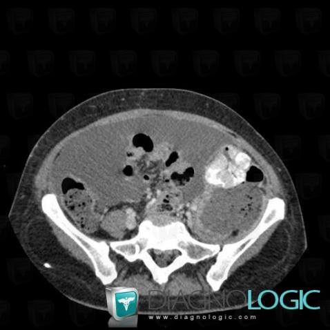 Peritoneal carcinomatosis, Mesentery / Peritoneum, CT