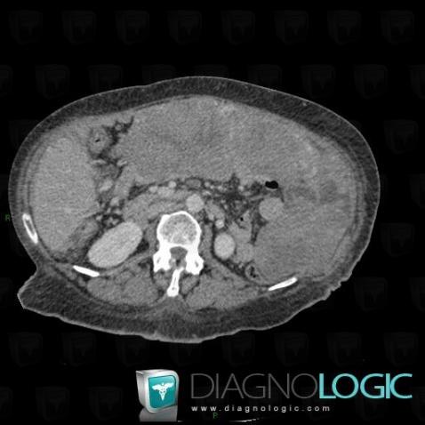 Peritoneal carcinomatosis, Mesentery / Peritoneum, CT