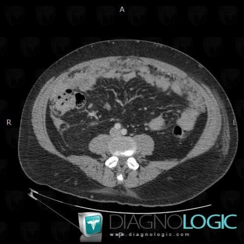 Peritoneal carcinomatosis, Mesentery / Peritoneum, CT