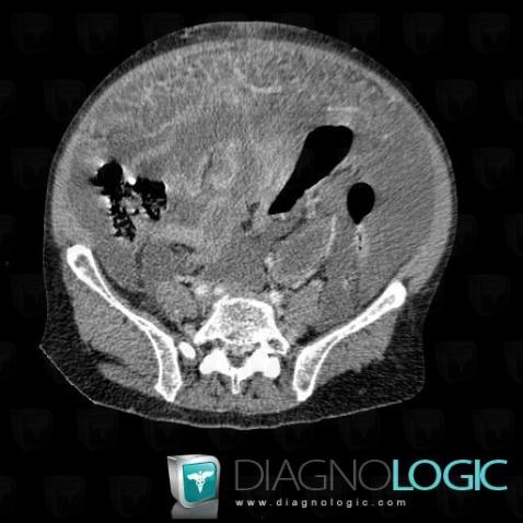 Peritoneal carcinomatosis, Mesentery / Peritoneum, CT