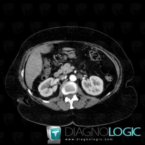 Peritoneal carcinomatosis, Mesentery / Peritoneum, CT