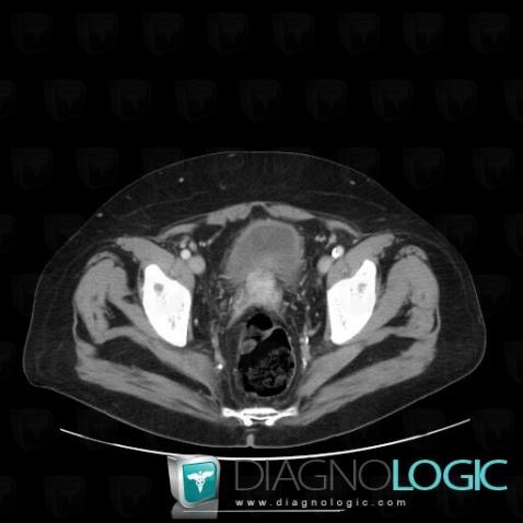 Peritoneal carcinomatosis, Mesentery / Peritoneum, CT