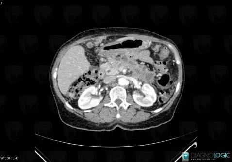 Peritoneal carcinomatosis, Mesentery / Peritoneum, CT