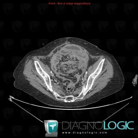 Peritoneal carcinomatosis, Mesentery / Peritoneum, CT