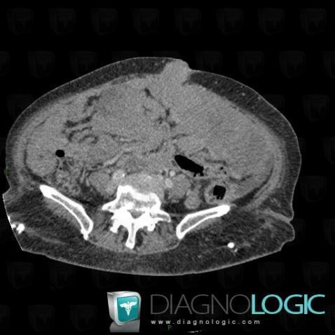 Peritoneal carcinomatosis, Small bowel, CT