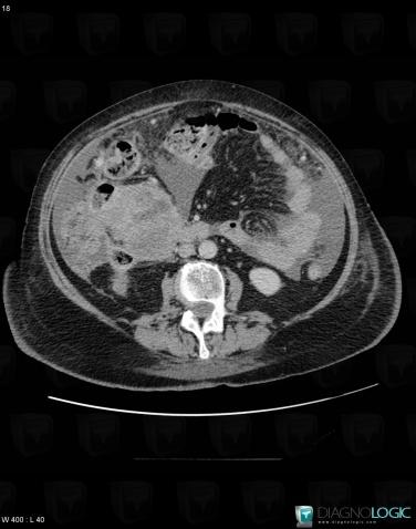 Peritoneal carcinomatosis, Small bowel, CT