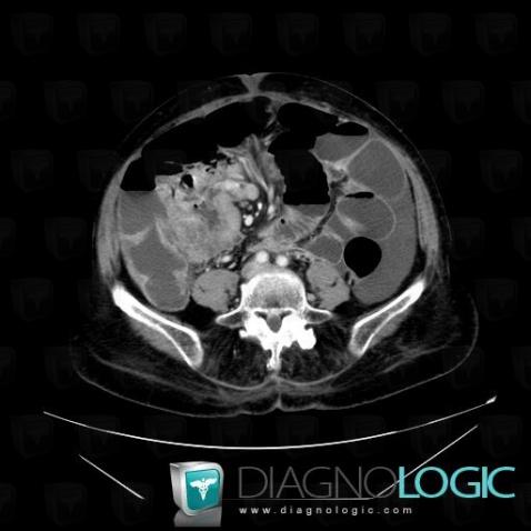 Peritoneal carcinomatosis, Small bowel, CT