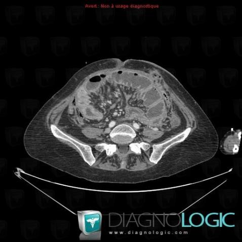 Peritoneal carcinomatosis, Small bowel, CT