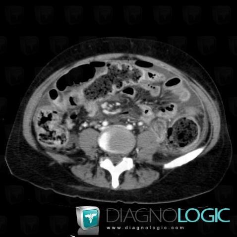 Peritonitis, Mesentery / Peritoneum, CT