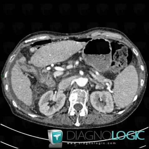 Peritonitis, Mesentery / Peritoneum, CT