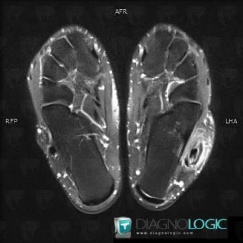 Peroneus brevis tendon longitudinal split, Fibularis tendons - Ankle, MRI