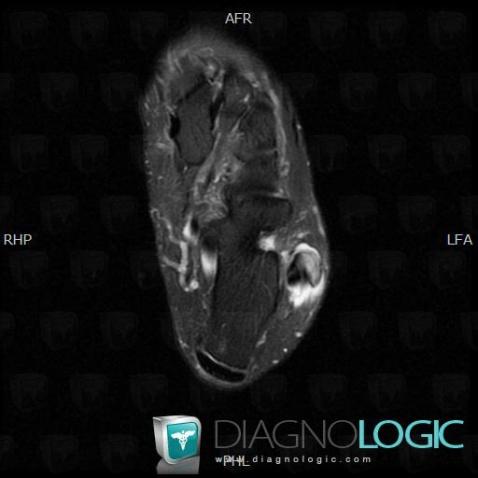 Peroneus brevis tendon longitudinal split, Fibularis tendons - Ankle, MRI