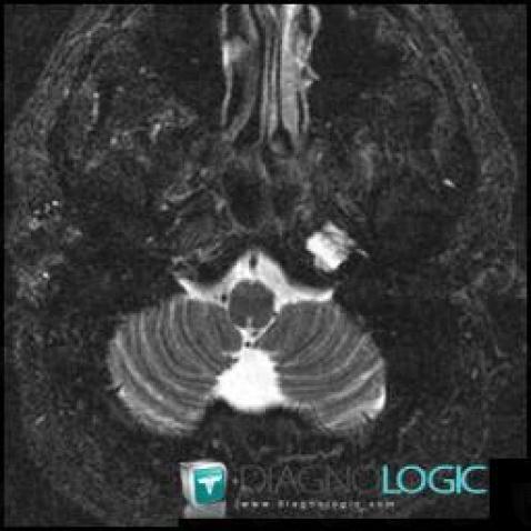 Petrous apicitis, Temporal bone, MRI