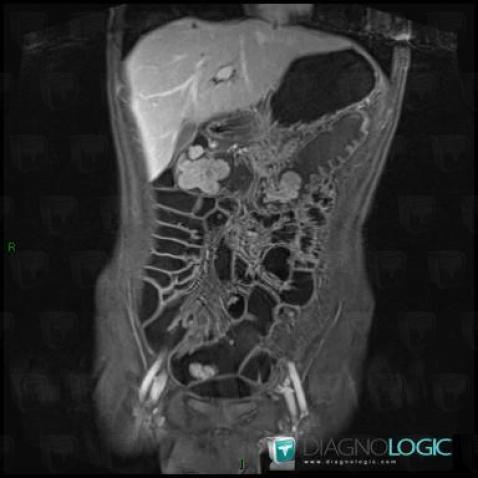 Peutz-Jeghers syndrome, Colon, MRI