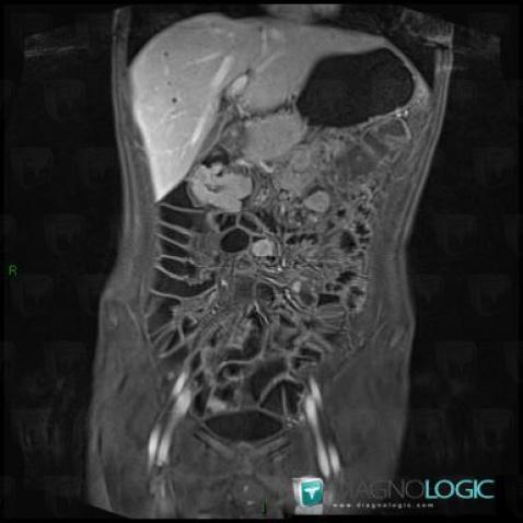 Peutz-Jeghers syndrome, Small bowel, MRI